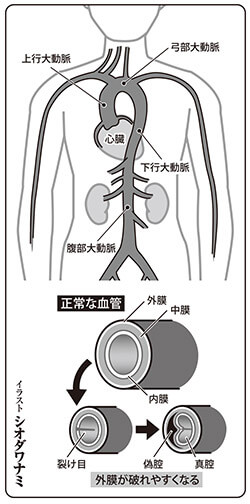 ベリベリと裂ける血管 大木凡人 快楽亭ブラック が証言 恐怖の大動脈解離 デイリー新潮