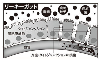 リーキーガット症候群