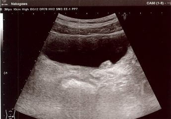 超音波エコーのモニターに映るがん