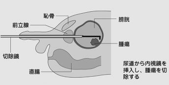 （図）膀胱がん