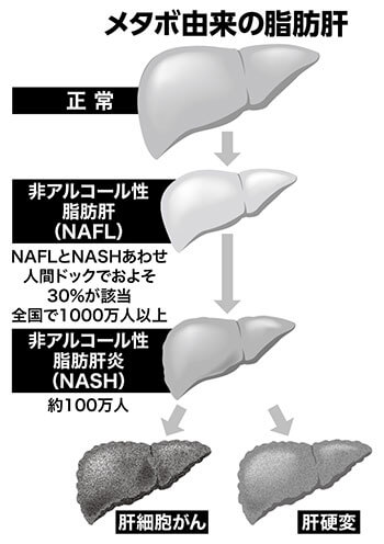 脂肪 肝 と は