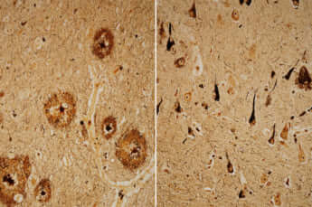 アミロイドベータ、タウ