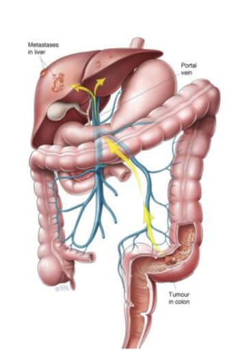 大腸がん肝転移のイメージ