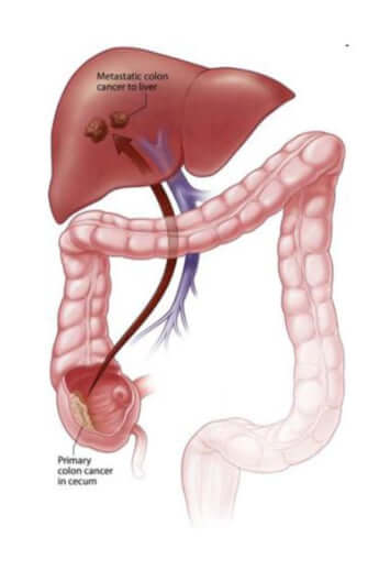 大腸がん肝転移の別イメージ