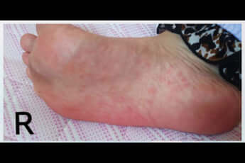 泥の華に聞く_梅毒患者が過去最高に2