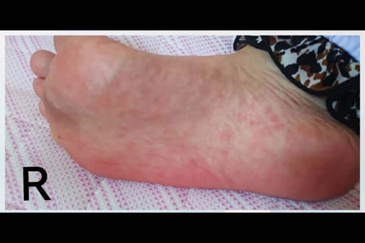 泥の華に聞く_梅毒患者が過去最高に2