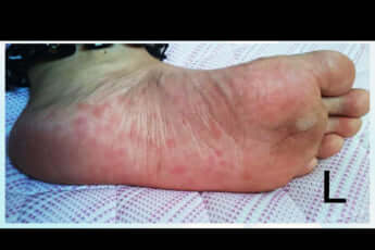 泥の華に聞く_梅毒患者が過去最高に3