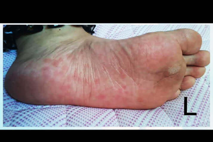 泥の華に聞く_梅毒患者が過去最高に3