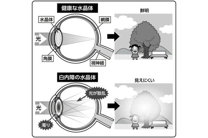 白内障の図解