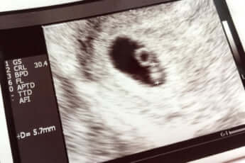 妊娠中の超音波写真