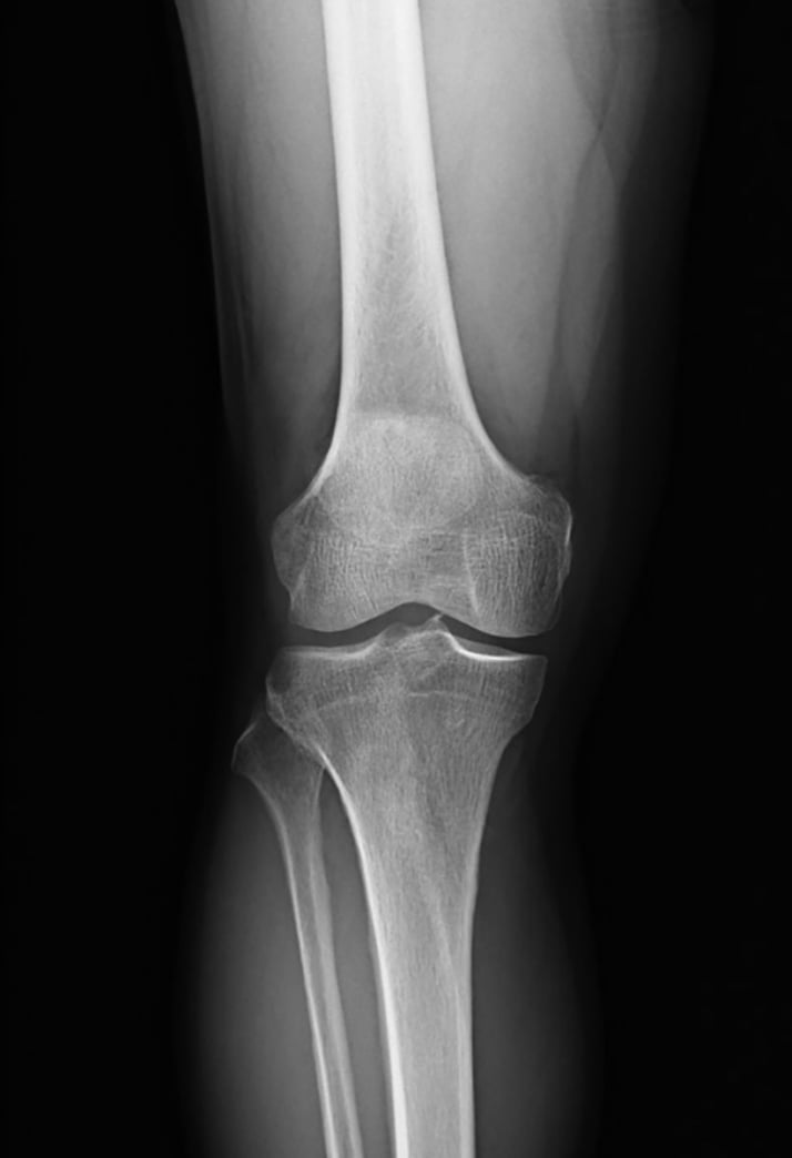 変形性膝関節症