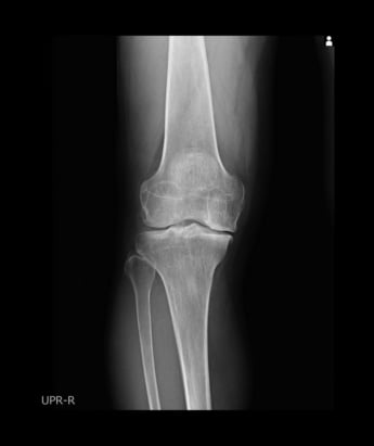 変形性膝関節症