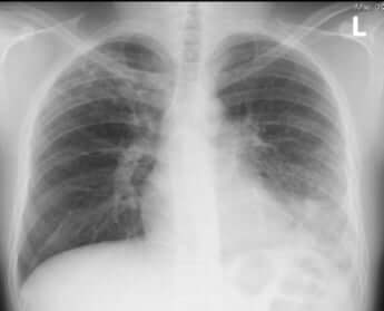 マイコプラズマに感染した患者の体内