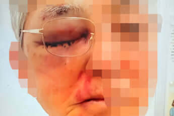 Aさん（eye）