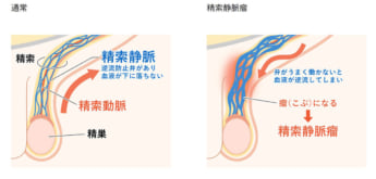 男性不妊3